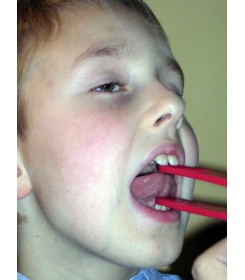 A boy using Talk Tools jaw exerciser